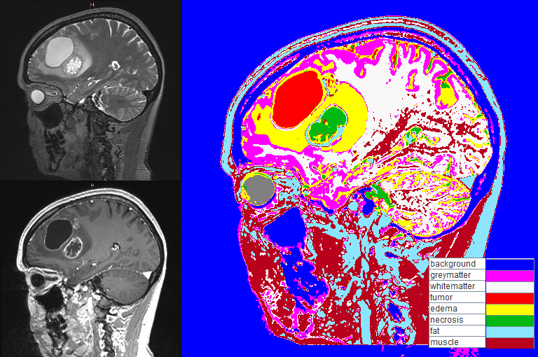 Abbildung 1 zeigt zwei kernspintomographische Schnittbilder durch den Schädel eines Tumorpatienten (links) und ein Klassifikationsergebnis mit farblich markierten Gewebetypen (rechts).
