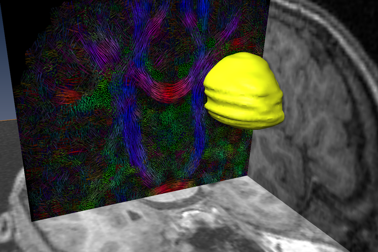 Abbildung 2 zeigt die Oberfläche eines Hirntumors (gelb) zusammen mit einem Schnittbild, das rekonstruierte Nervenbahnen visualisiert.